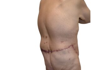 After body contouring following weight loss, back right oblique view of a male patient treated by Dr. Benjamin Eskenazi at Avabello Aesthetics in Miami Beach.