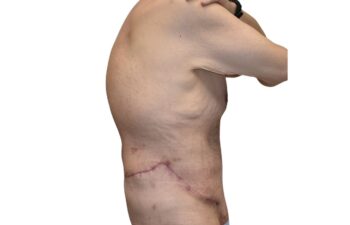 After body contouring following weight loss, right view of a male patient treated by Dr. Benjamin Eskenazi at Avabello Aesthetics in Miami Beach.
