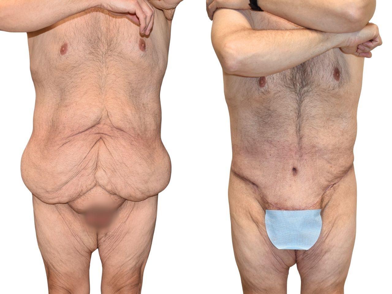 Before and after body contouring following weight loss, front view of a male patient treated by Dr. Benjamin Eskenazi at Avabello Aesthetics in Miami Beach.