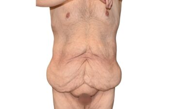 Before body contouring following weight loss, front view of a male patient treated by Dr. Benjamin Eskenazi at Avabello Aesthetics in Miami Beach.