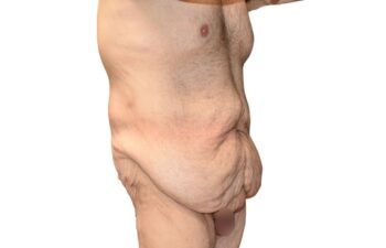 Before body contouring following weight loss, right oblique view of a male patient treated by Dr. Benjamin Eskenazi at Avabello Aesthetics in Miami Beach.