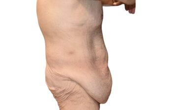 Before body contouring following weight loss, right view of a male patient treated by Dr. Benjamin Eskenazi at Avabello Aesthetics in Miami Beach.