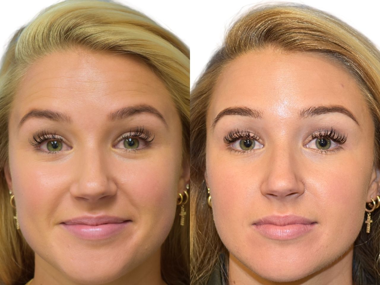 Before and after botox treatment, front view of female patient, Dr. Benjamin Eskenazi at Avabello Aesthetics, Miami Beach.