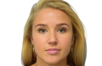 Before botox treatment, front view of female patient, Dr. Benjamin Eskenazi at Avabello Aesthetics, Miami Beach.