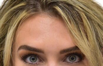 After botox treatment, front view of female patient, Dr. Benjamin Eskenazi at Avabello Aesthetics, Miami Beach.