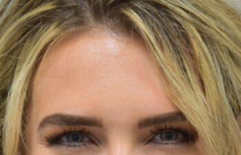 After botox treatment, front view of female patient, Dr. Benjamin Eskenazi at Avabello Aesthetics, Miami Beach.