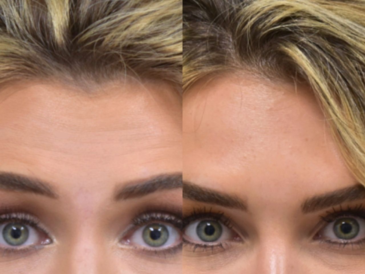 Before and after botox treatment, front view of female patient, Dr. Benjamin Eskenazi at Avabello Aesthetics, Miami Beach.
