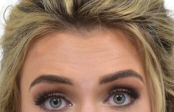 Before botox treatment, front view of female patient, Dr. Benjamin Eskenazi at Avabello Aesthetics, Miami Beach.