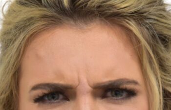 Before botox treatment, front view of female patient, Dr. Benjamin Eskenazi at Avabello Aesthetics, Miami Beach.