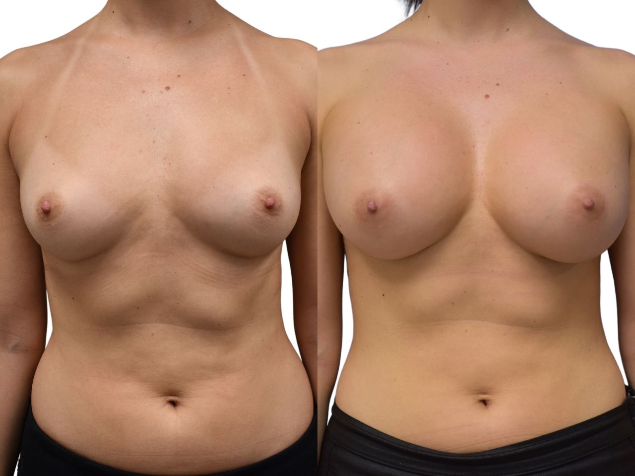 Before and after breast augmentation surgery, front view of a female patient treated by Dr. Benjamin Eskenazi at Avabello Aesthetics in Miami Beach.