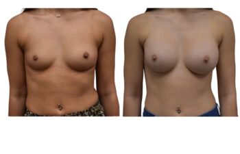 Before and after breast augmentation surgery, front view of a female patient treated by Dr. Benjamin Eskenazi at Avabello Aesthetics in Miami Beach.