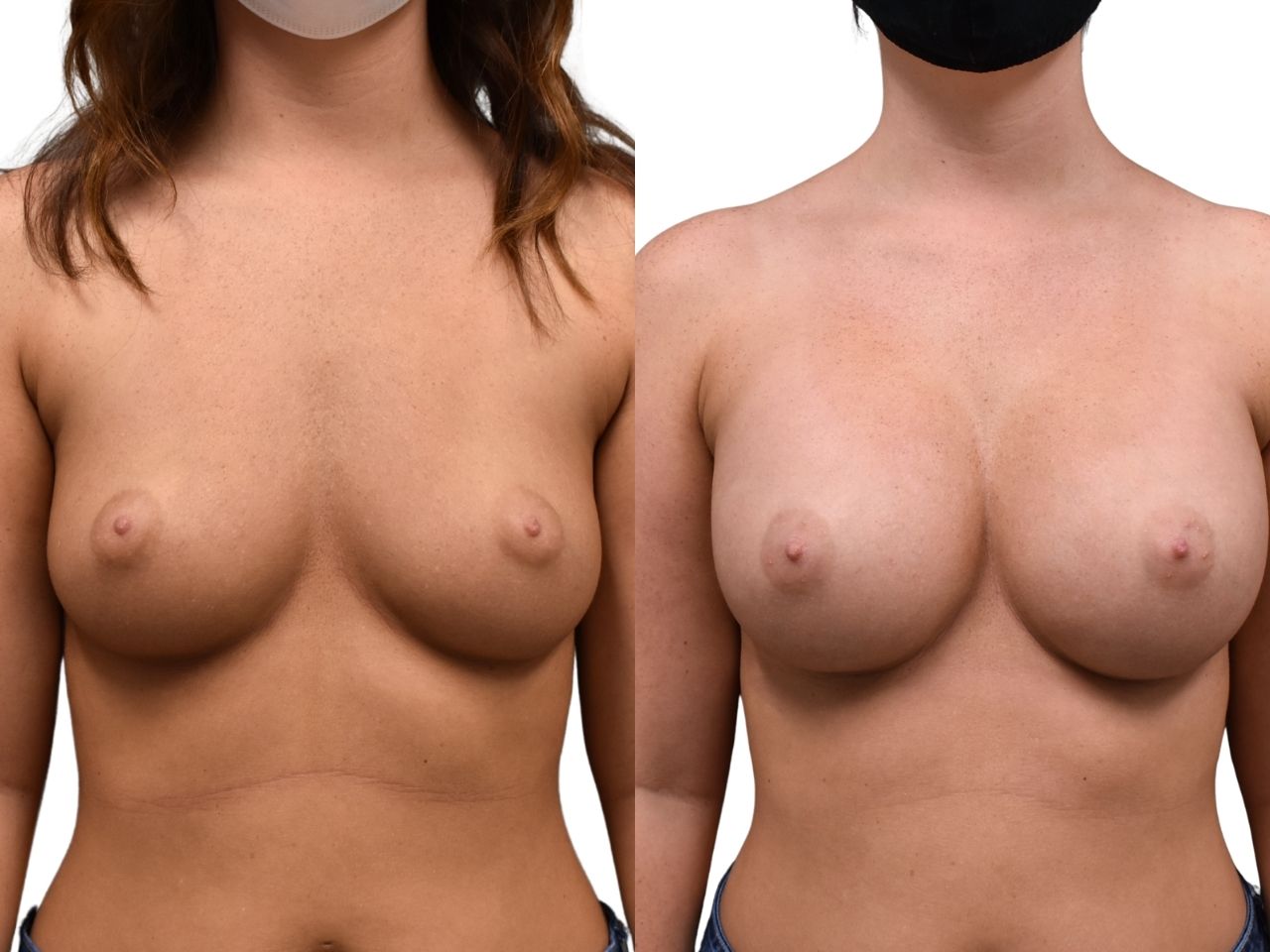 Before and after breast augmentation surgery, front view of a female patient treated by Dr. Benjamin Eskenazi at Avabello Aesthetics in Miami Beach.
