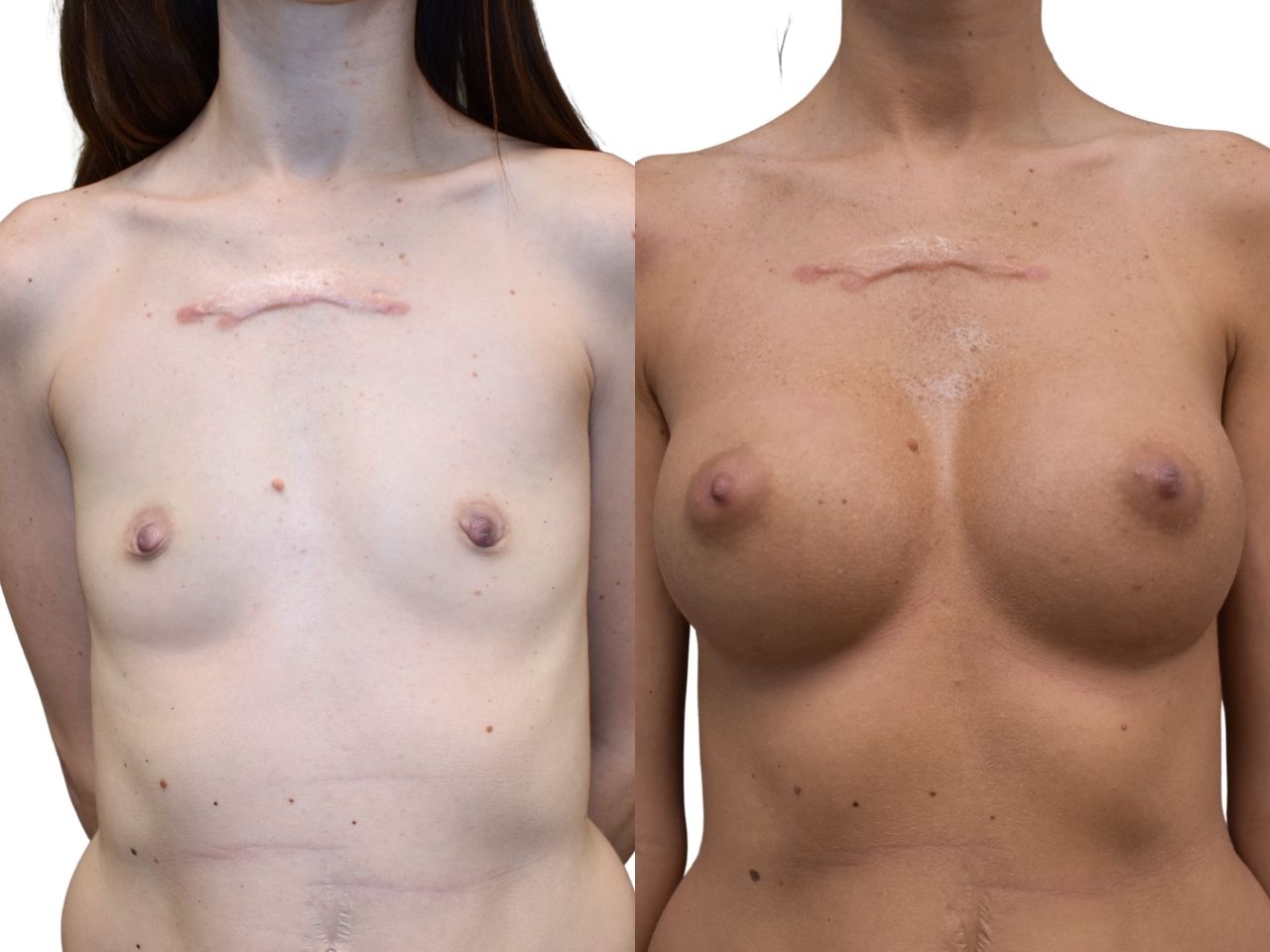 Before and after breast augmentation surgery, front view of a female patient treated by Dr. Benjamin Eskenazi at Avabello Aesthetics in Miami Beach.