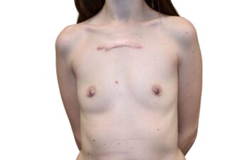 Before breast augmentation surgery, front view of a female patient treated by Dr. Benjamin Eskenazi at Avabello Aesthetics in Miami Beach.