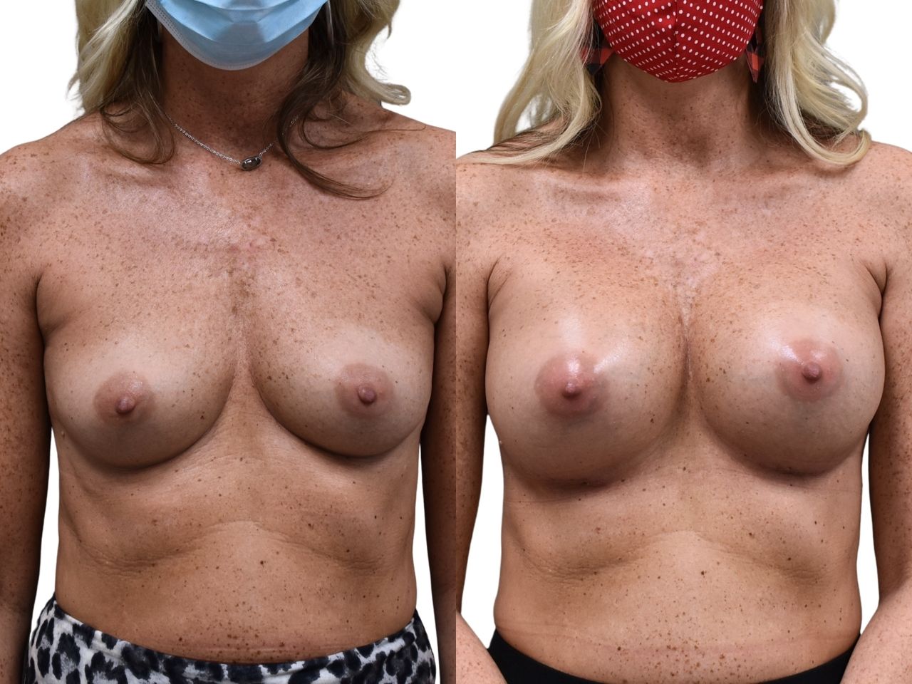Before and after breast augmentation surgery, front view of a female patient treated by Dr. Benjamin Eskenazi at Avabello Aesthetics in Miami Beach.