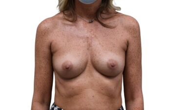 Before breast augmentation surgery, front view of a female patient treated by Dr. Benjamin Eskenazi at Avabello Aesthetics in Miami Beach.