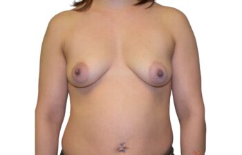 Before breast augmentation surgery, front view of a female patient treated by Dr. Benjamin Eskenazi at Avabello Aesthetics in Miami Beach.
