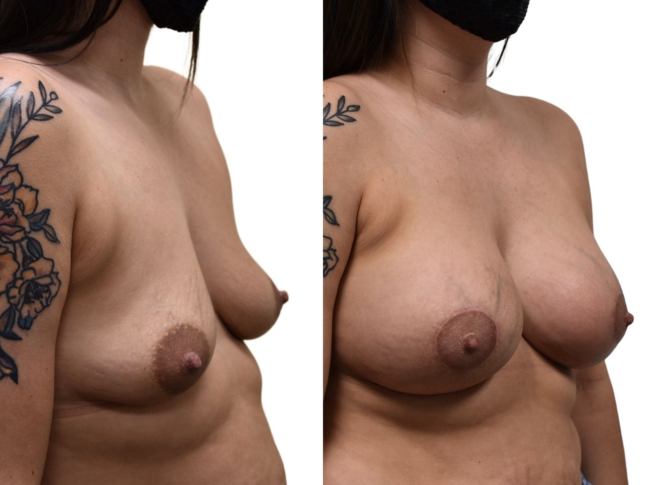 Before and after breast augmentation surgery, front view of a female patient treated by Dr. Benjamin Eskenazi at Avabello Aesthetics in Miami Beach.