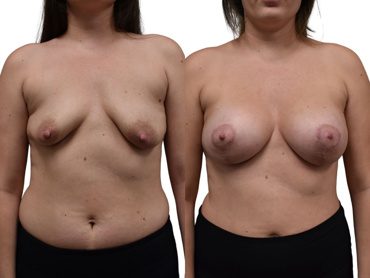 Before and after breast augmentation with mastopexy, front view of a female patient treated by Dr. Benjamin Eskenazi at Avabello Aesthetics.