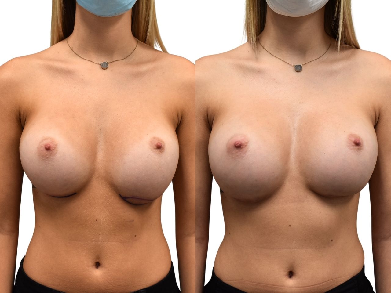 Befor and after breast bottoming out correction, front view of a female patient treated by Dr. Benjamin Eskenazi at Avabello Aesthetics