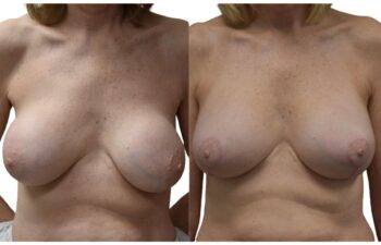 Before and after breast implant exchange, front view of a female patient treated by Dr. Benjamin Eskenazi at Avabello Aesthetics in Miami Beach.