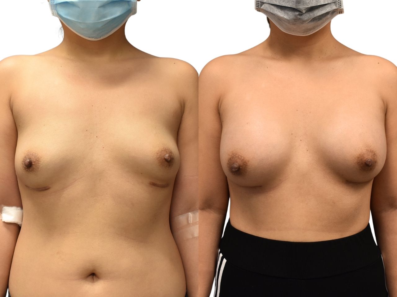 Before and after correction of breast keloids and capsular contracture, front view of a female patient treated by Dr. Benjamin Eskenazi at Avabello Aesthetics