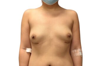 After correction of breast keloids and capsular contracture, front view of a female patient treated by Dr. Benjamin Eskenazi at Avabello Aesthetics