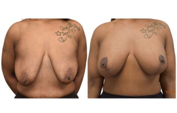 Before and after breast lift, front view of a female patient treated by Dr. Benjamin Eskenazi at Avabello Aesthetics in Miami Beach.