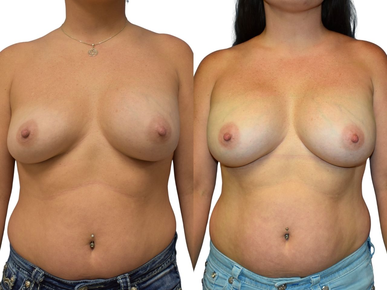 Before and After breast saline implant deflation, front view of a female patient treated by Dr. Benjamin Eskenazi at Avabello Aesthetics
