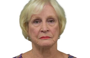 After brow lift surgery, front view of a female patient treated by Dr. Benjamin Eskenazi at Avabello Aesthetics in Miami Beach.