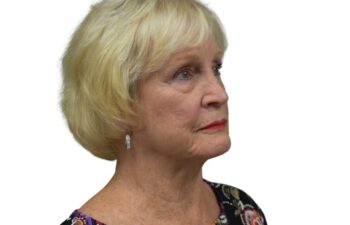 After brow lift surgery, right oblique view of a female patient treated by Dr. Benjamin Eskenazi at Avabello Aesthetics in Miami Beach.