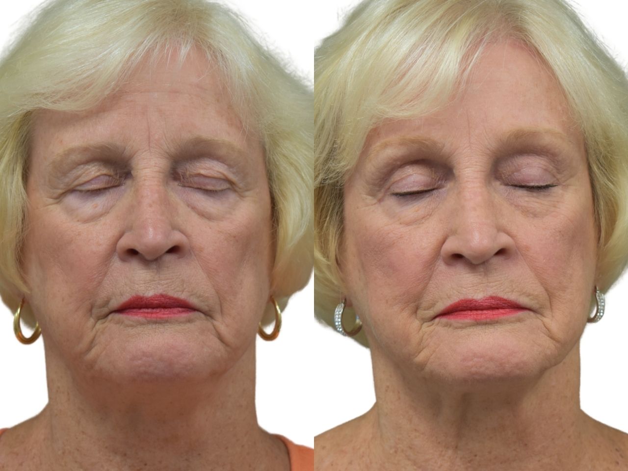 Before and after brow lift surgery, front view of a female patient treated by Dr. Benjamin Eskenazi at Avabello Aesthetics in Miami Beach.