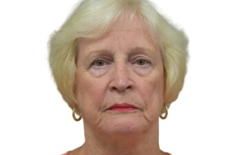 Before brow lift surgery, front view of a female patient treated by Dr. Benjamin Eskenazi at Avabello Aesthetics in Miami Beach.