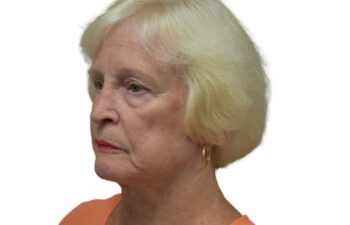 Before brow lift surgery, left oblique view of a female patient treated by Dr. Benjamin Eskenazi at Avabello Aesthetics in Miami Beach.