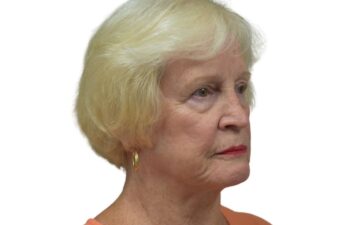 Before brow lift surgery, right oblique view of a female patient treated by Dr. Benjamin Eskenazi at Avabello Aesthetics in Miami Beach.