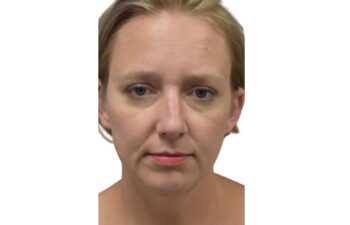 After chin implant, front view of a female patient treated by Dr. Benjamin Eskenazi at Avabello Aesthetics in Miami Beach.