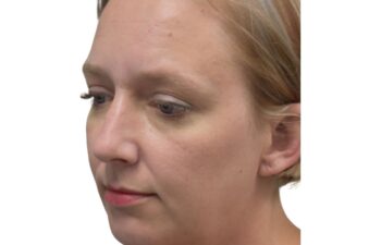 After chin implant, left oblique view of a female patient treated by Dr. Benjamin Eskenazi at Avabello Aesthetics in Miami Beach.