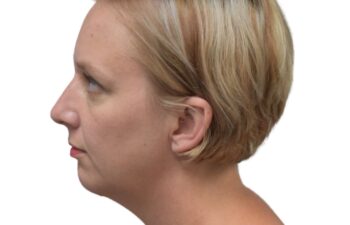 After chin implant, left view of a female patient treated by Dr. Benjamin Eskenazi at Avabello Aesthetics in Miami Beach.