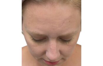 After chin implant, up view of a female patient treated by Dr. Benjamin Eskenazi at Avabello Aesthetics in Miami Beach.