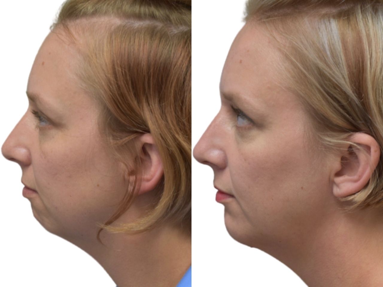 Before and after chin implant, left view of a female patient treated by Dr. Benjamin Eskenazi at Avabello Aesthetics in Miami Beach.