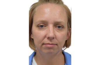 Before chin implant, front view of a female patient treated by Dr. Benjamin Eskenazi at Avabello Aesthetics in Miami Beach.