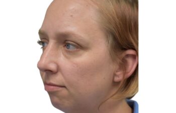 Before chin implant, left oblique view of a female patient treated by Dr. Benjamin Eskenazi at Avabello Aesthetics in Miami Beach.