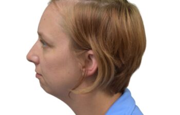 After chin implant, left view of a female patient treated by Dr. Benjamin Eskenazi at Avabello Aesthetics in Miami Beach.