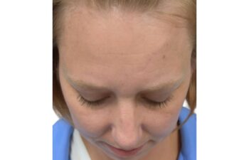 After chin implant, up view of a female patient treated by Dr. Benjamin Eskenazi at Avabello Aesthetics in Miami Beach.