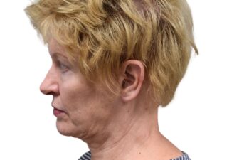 After earlobe reduction left view of a female patient treated by Dr. Benjamin Eskenazi at Avabello Aesthetics in Miami Beach.