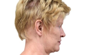 After earlobe reduction right view of a female patient treated by Dr. Benjamin Eskenazi at Avabello Aesthetics in Miami Beach.