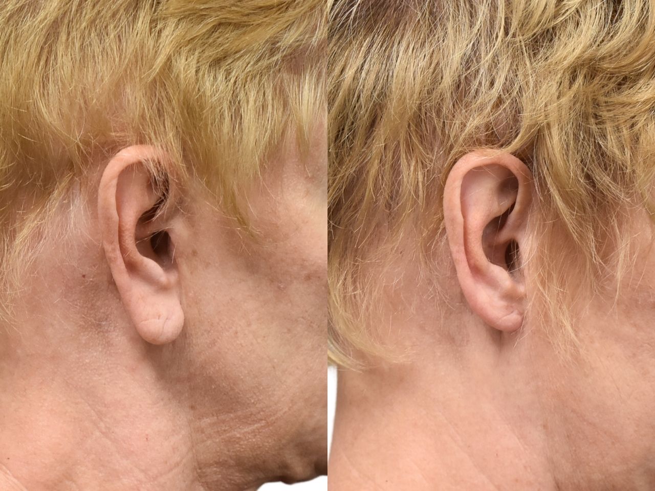 Before and after earlobe reduction right view of a female patient treated by Dr. Benjamin Eskenazi at Avabello Aesthetics in Miami Beach.