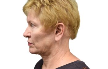 Before earlobe reduction left view of a female patient treated by Dr. Benjamin Eskenazi at Avabello Aesthetics in Miami Beach.