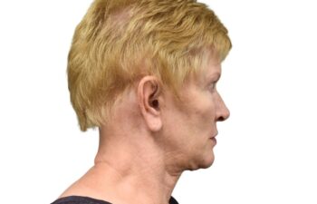 Before earlobe reduction right view of a female patient treated by Dr. Benjamin Eskenazi at Avabello Aesthetics in Miami Beach.