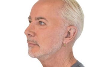 After facelift, left oblique view of a male patient treated by Dr. Benjamin Eskenazi at Avabello Aesthetics in Miami Beach.